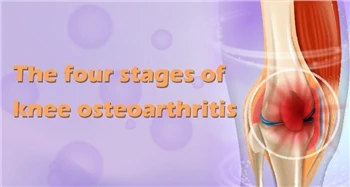 Las cuatro etapas de la artrosis de rodilla